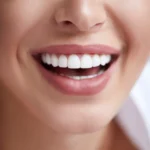 Solving Gummy Smiles: Innovative Techniques for a Balanced Look